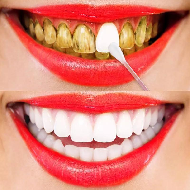 如何去除厚厚的牙垢,几个去除牙垢小妙招