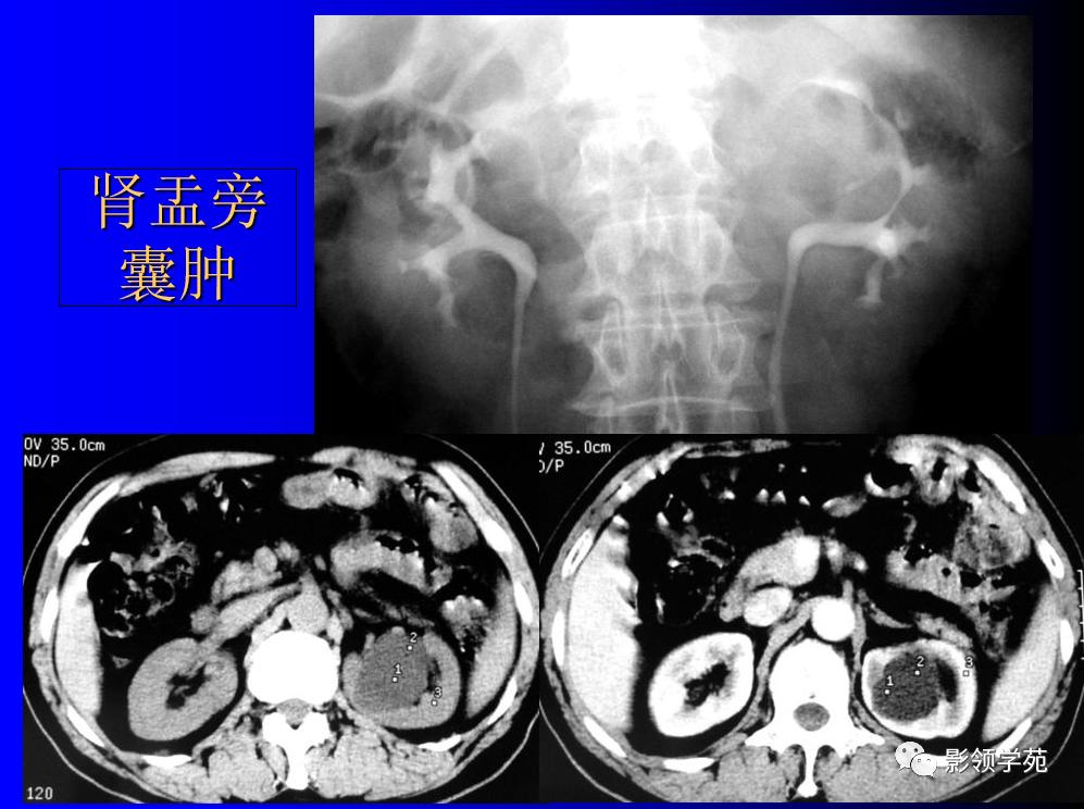 肾脏囊性肿块的影像学特点,肾脏典型病理图片及解析