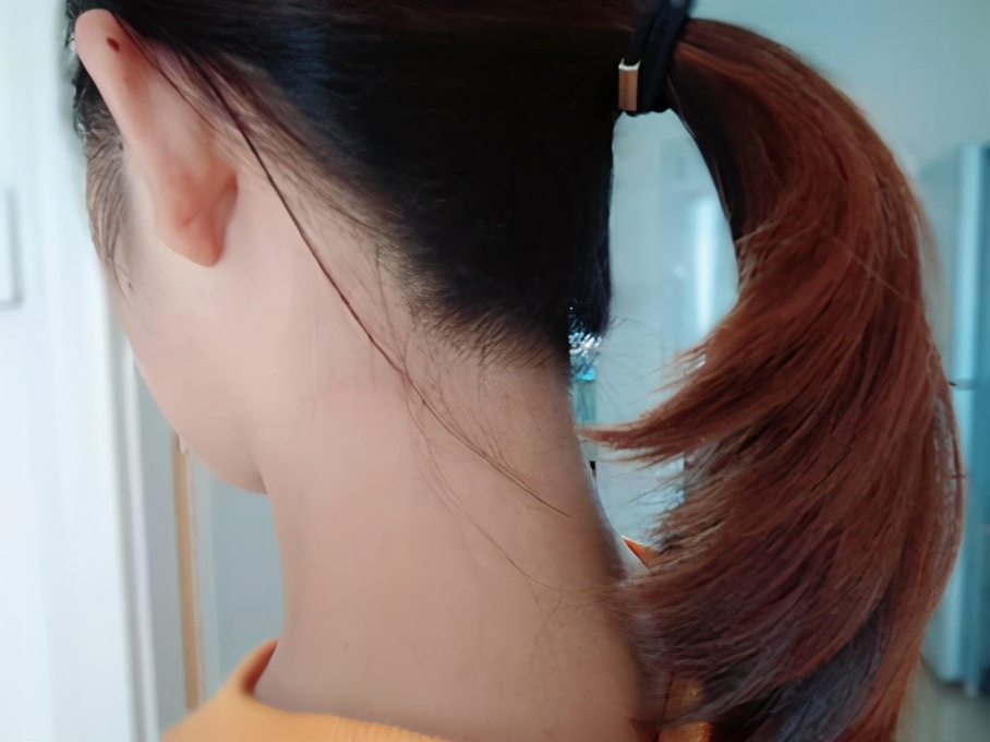 发际线可以激光脱毛吗,后发际线脱毛对比照片