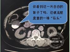 胆囊里边有石头需要切除吗,胆囊长满石头该咋办