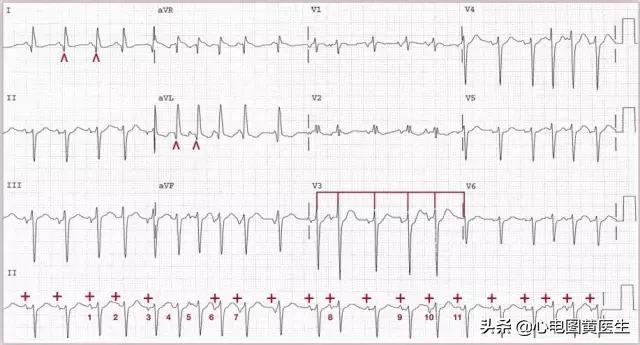 多形性室性心动过速心电图图片,心电图临床意义及正常值