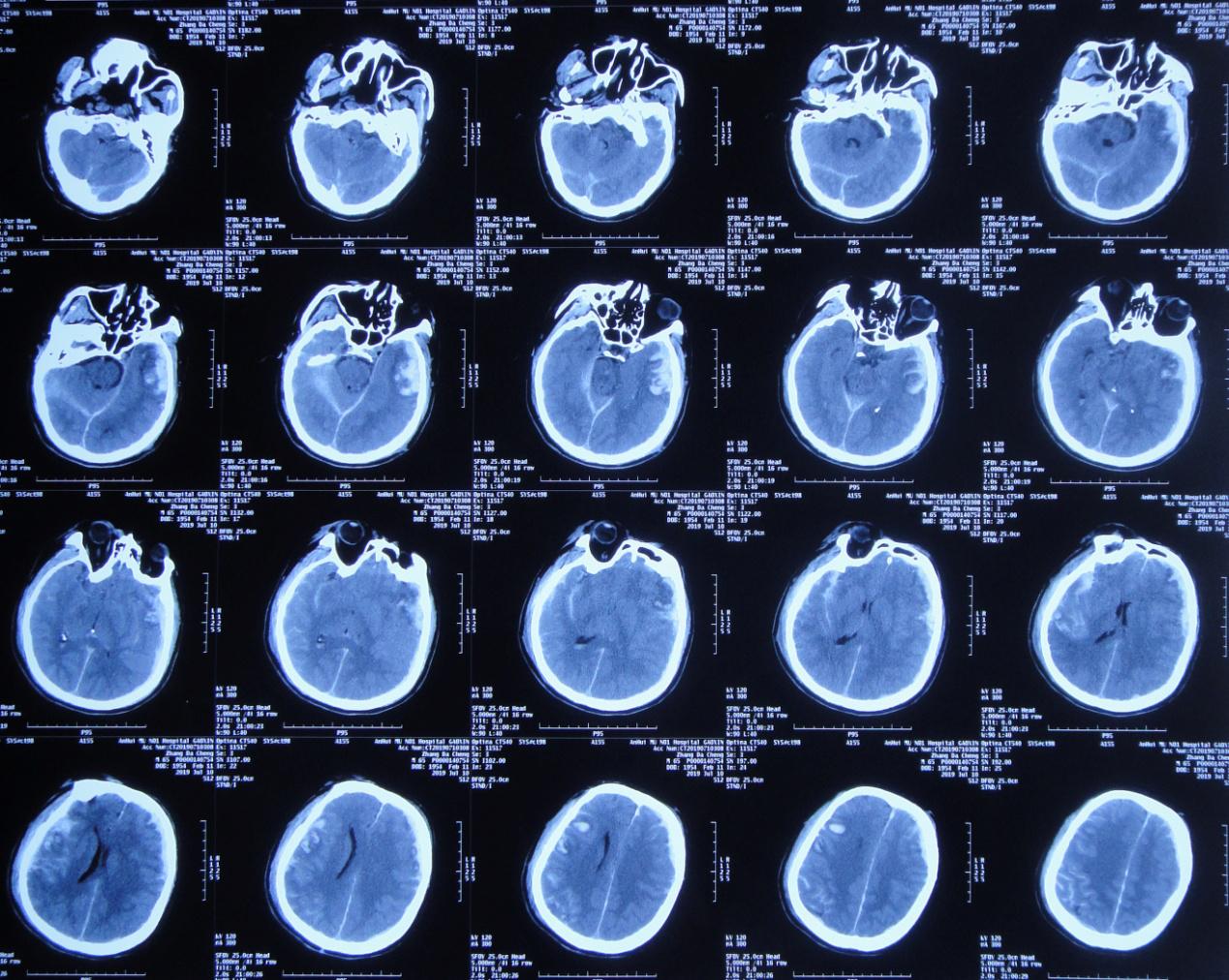 颅脑外伤术后脑积水,脑外伤脑积水颅骨缺失