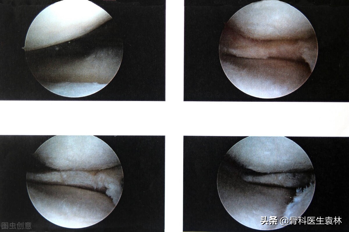 半月板撕裂缝合3个月走路里面疼,半月板缝合术肌肉萎缩走路会好吗
