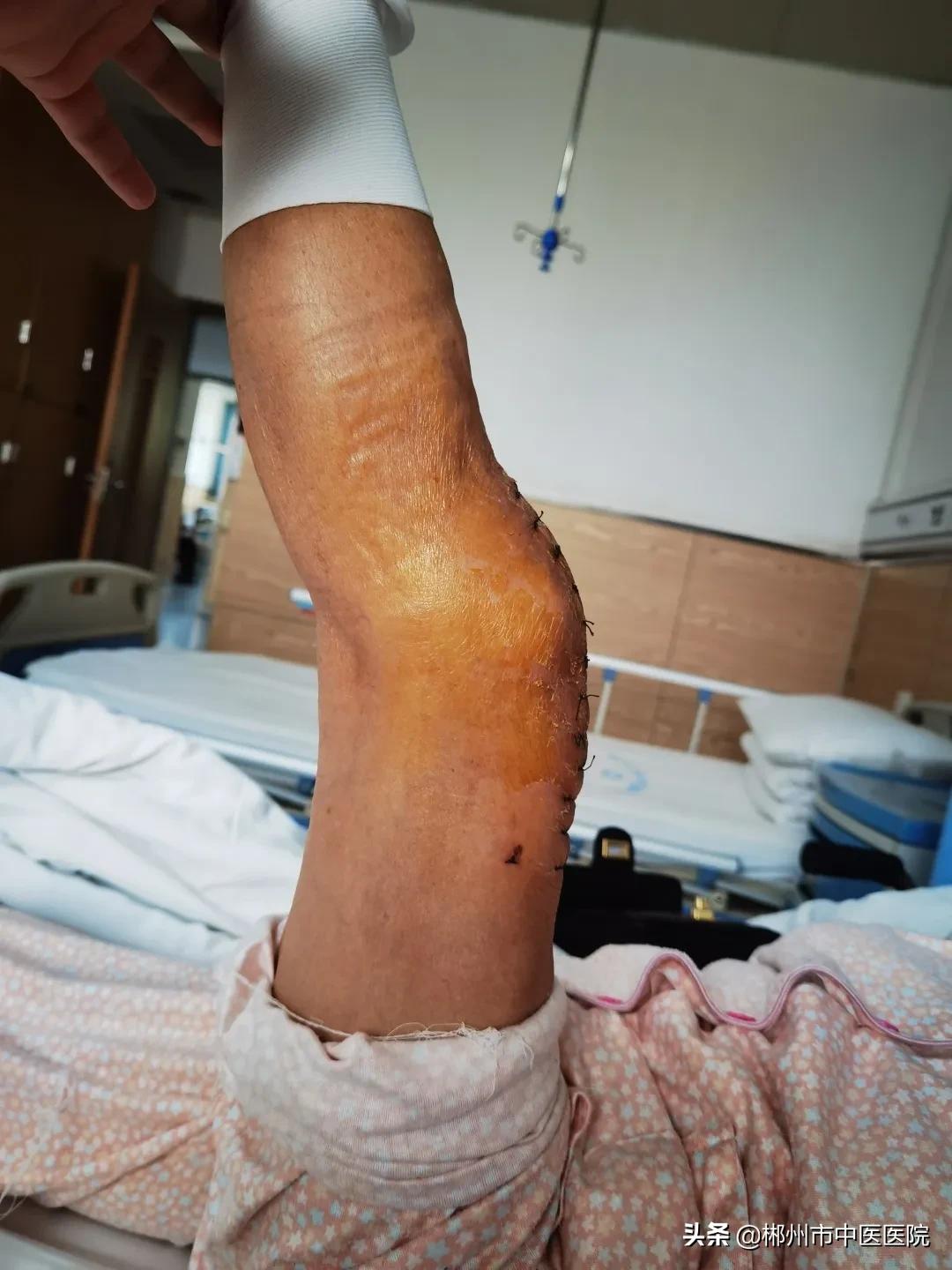 专家支招骨关节炎治疗,膝关节骨性关节炎疼痛怎么治疗