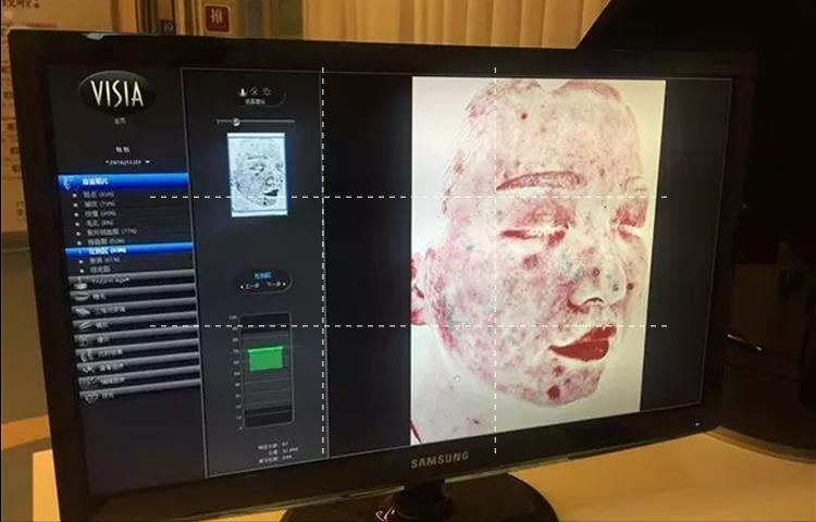 雀斑不多怎么去除女生,雀斑不用钱怎么去掉