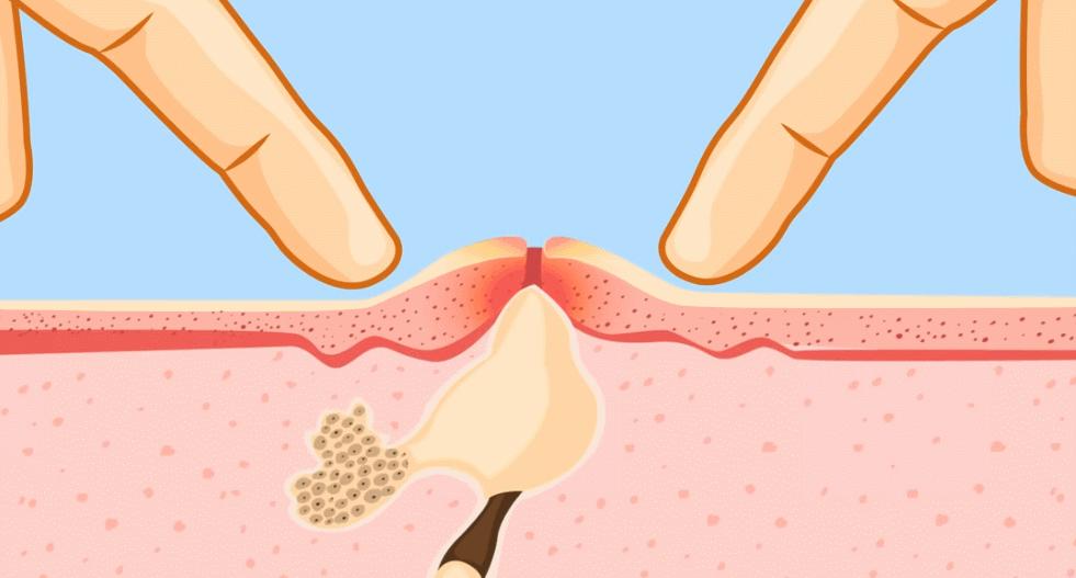 闭口红痘痘反反复复,痘痘闭口多用什么药好得快