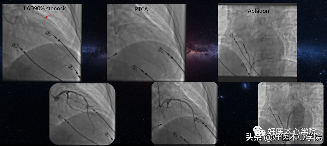 安贞医院冠心病介入治疗新技术,冠心病介入术