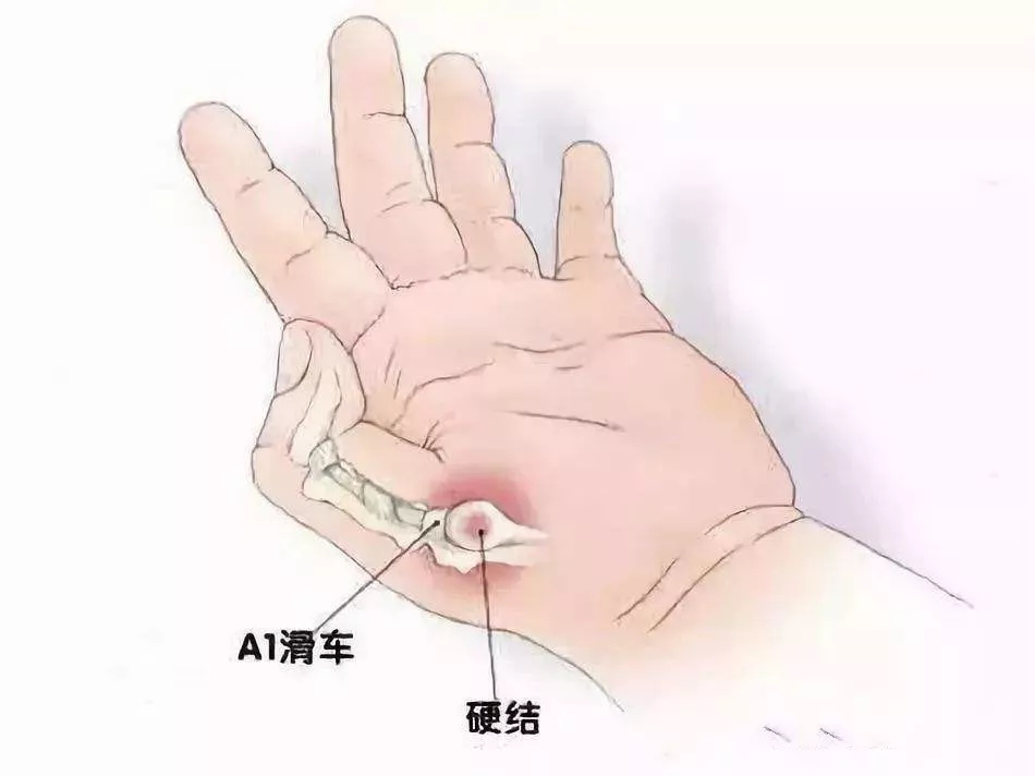 手指肌腱水肿怎么办,腱鞘炎手指肿胀怎么治最好