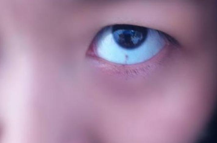 小孩眼白有黑点是啥原因,儿童眼白有黑点是怎么回事