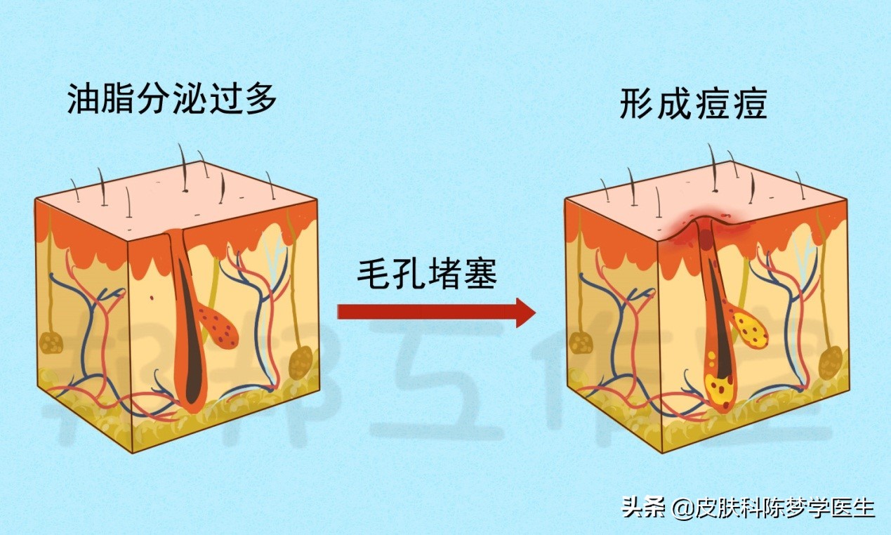 脸上青春痘用什么药膏,青春痘祛痘印推荐药物有哪些