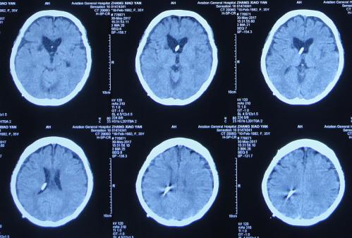 结核性脑积水,脑膜炎脑积水要治疗多久