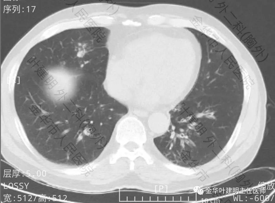 肺多发转移癌主要治疗手段,右肺上叶癌怎么治疗