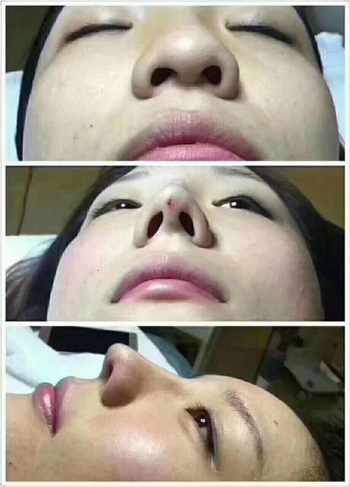 隆鼻几年发现鼻子有点歪,隆鼻鼻子做歪了怎么办