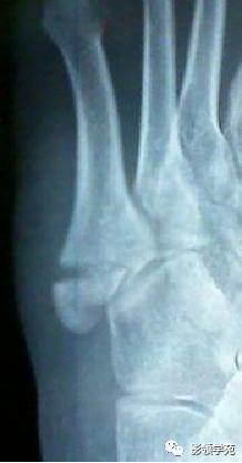 桡骨远端骨折引起尺骨变异,撕脱骨折一个月无明显骨痂形成