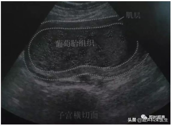 妇科超声的标准超声图,妇科超声图解