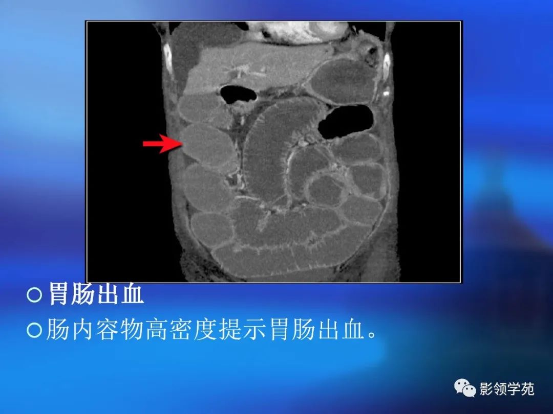 肠道内壁增厚,肠道扩张ct表现
