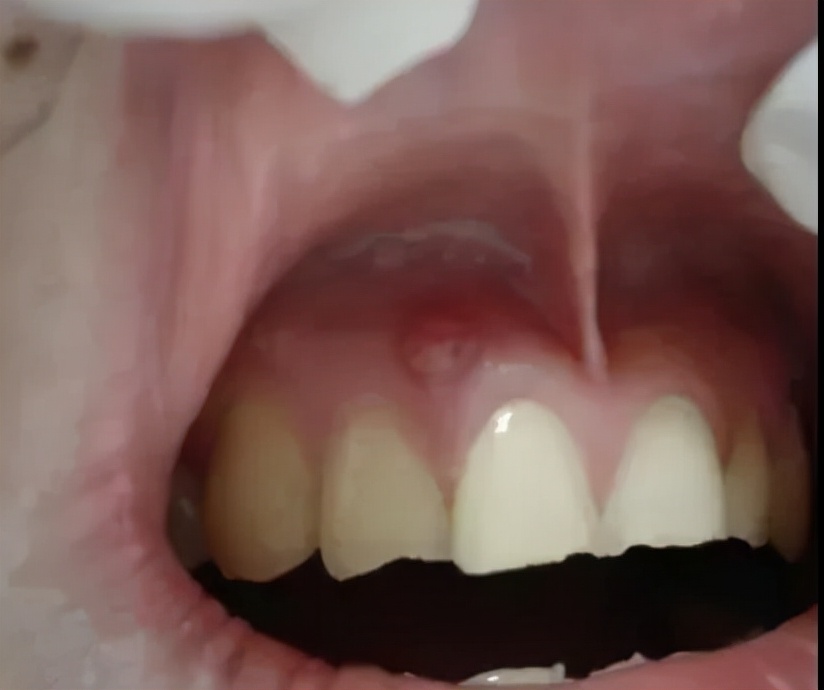 牙齿坏了牙龈上反复长脓包怎么办,蛀牙牙龈上面反复出现脓包怎么办