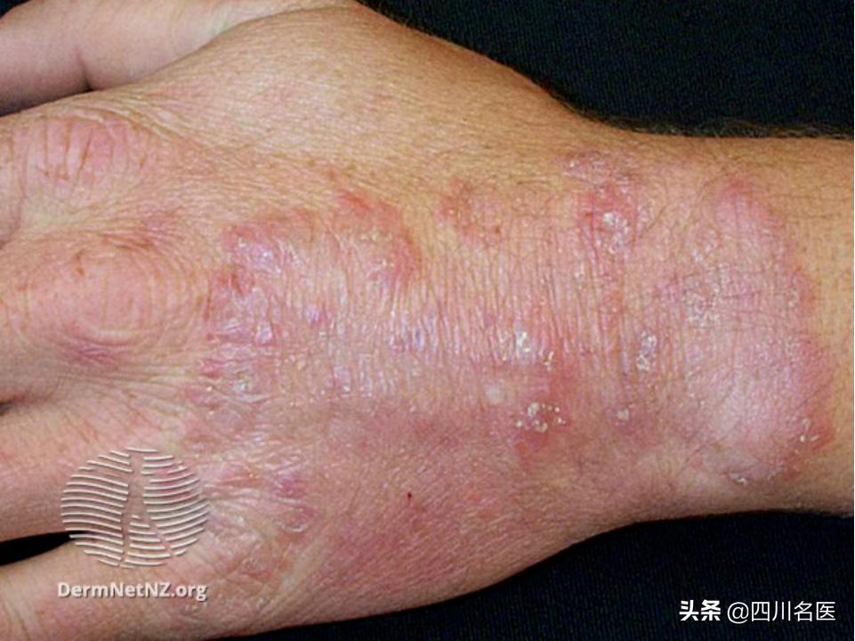 一到夏天手上起小水泡痒注意事项,手上长小水泡可能是什么原因引起