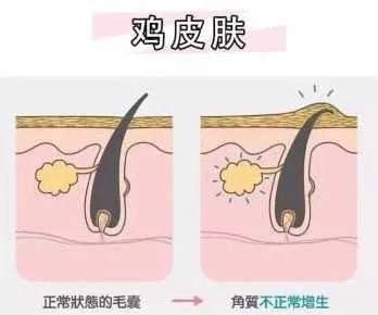 小孩脸两侧鸡皮肤怎么消除最有效,后背鸡皮肤怎么消除最有效