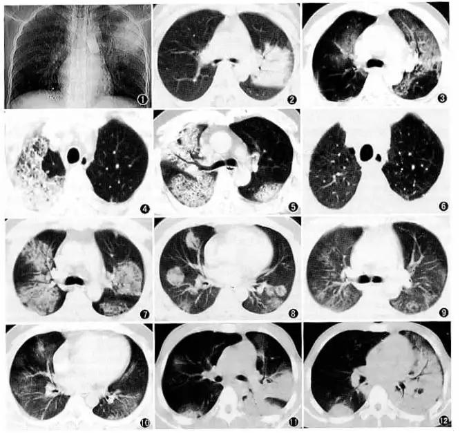 高血压合并新冠病例,高血压合并新冠肺炎