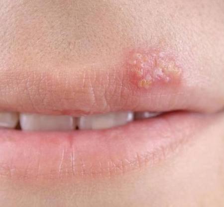 嘴边起泡是什么病毒,嘴边上火起泡可以用红霉素软膏吗