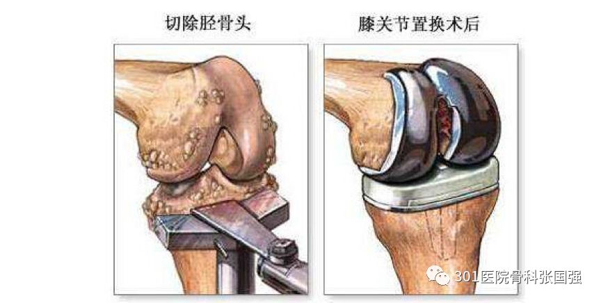 膝关节置换多久就不怕感染了,膝关节置换术感染的几率是多少