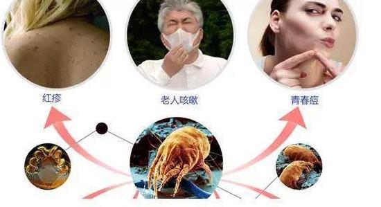 四种螨虫都是什么螨虫,皮肤上有螨虫的表现