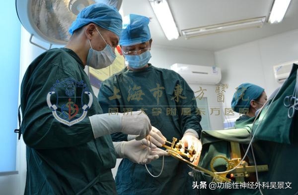 癫痫热凝术复发率高吗,难治癫痫可以用新药控制住吗