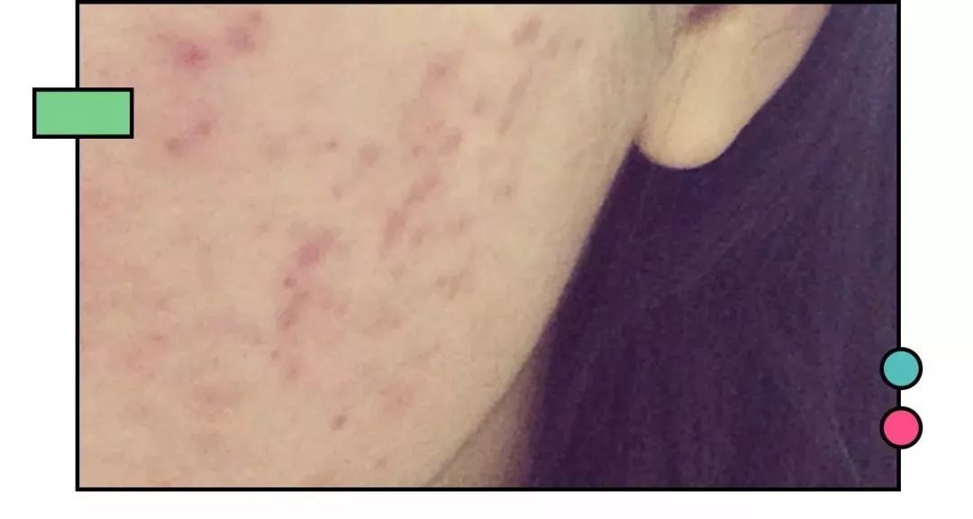 痘印多久才能消如何快速消除痘印,如何有效祛痘印看完你就知道了