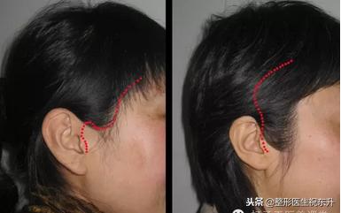 额颞部除皱去抬头纹怎么样,拉皮除皱抬头纹全过程视频