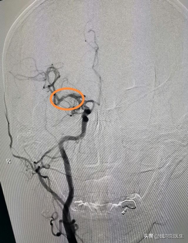 做了胃镜为什么不能吃饭,做胃镜一下子就没有意识了