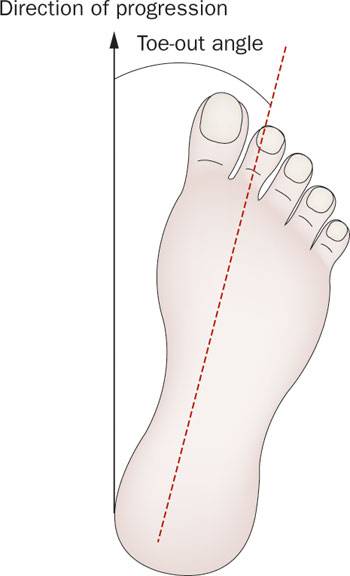 外八字脚会不会影响膝盖,跑步时八字脚产生原因及纠正方法
