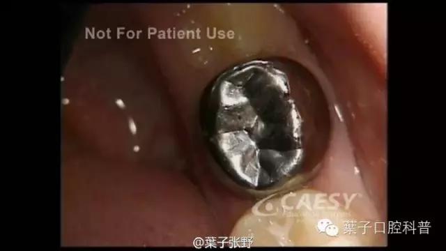 上牙龈上火突出一个鼓包,牙龈肿胀鼓包上火了吗