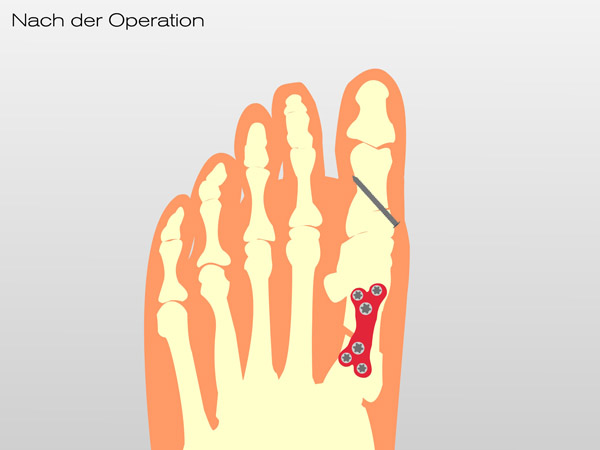 真实的重度大脚骨矫正案例,哈尔滨做大脚骨手术