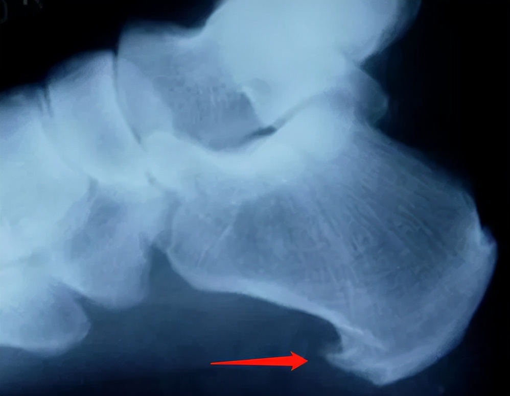 跟骨骨折和足跟骨刺哪个严重,足跟骨刺走路疼痛该如何治疗