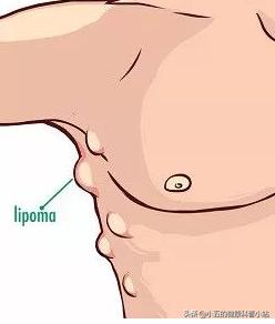 什么叫做脂肪瘤该怎么医治,脂肪瘤有什么危害脂肪瘤最怕什么
