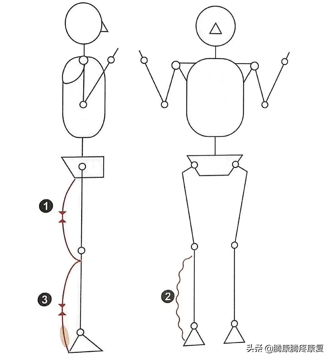 跟腱炎诊疗计划,跟腱炎四个痛点