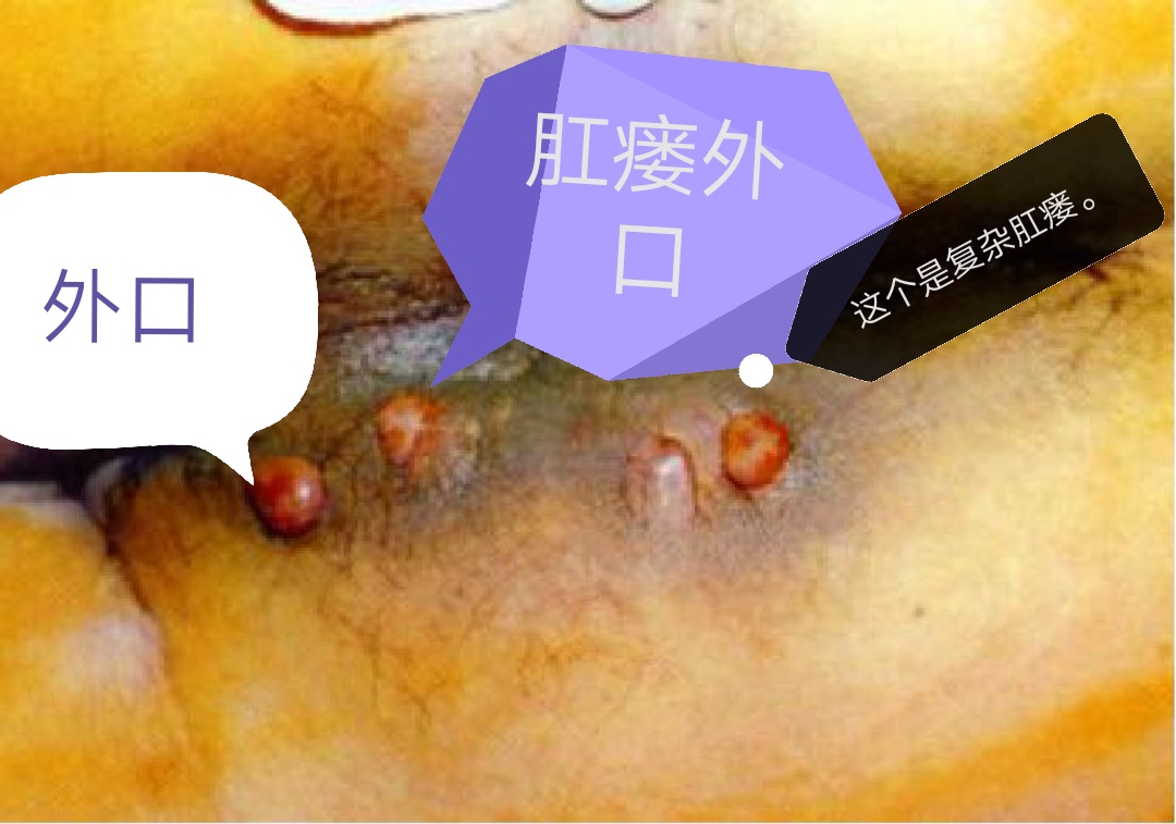 肛瘘手术后有坠胀是怎么回事,肛瘘手术后有个肉球是怎么回事