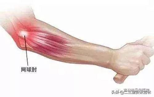 国家队怎么治网球肘,为啥有人得网球肘