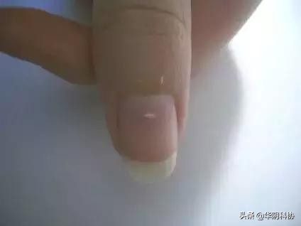 指甲上没月牙有横线长倒刺,关于指甲的科普指甲上的疾病视频
