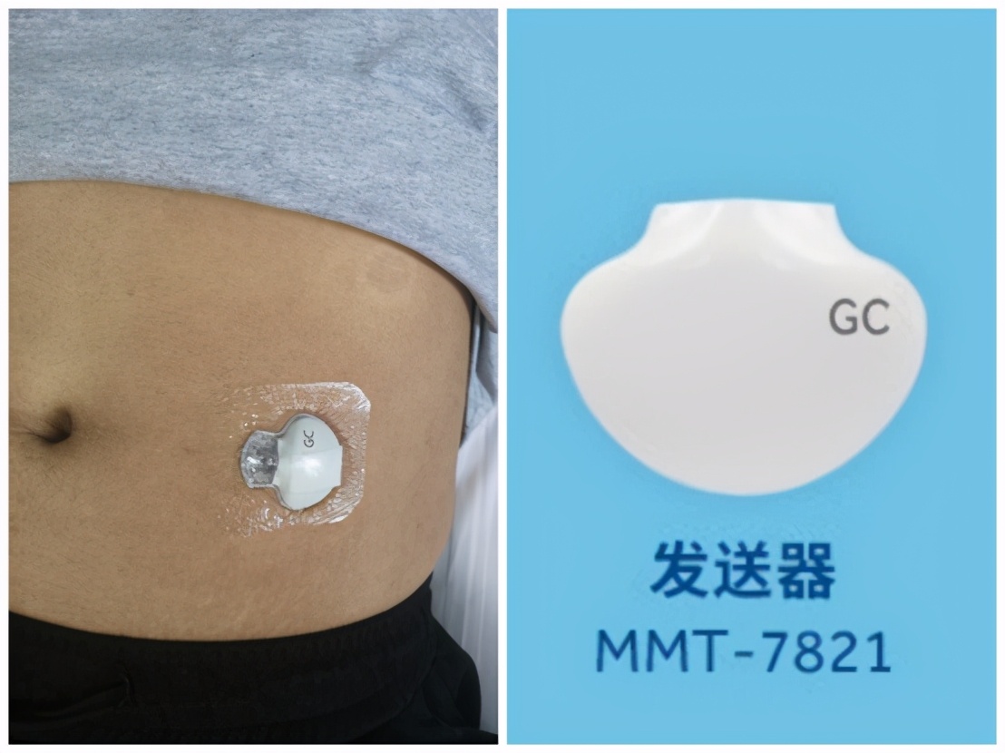 晋城市第二人民医院测血糖多钱,晋城二院糖尿病科