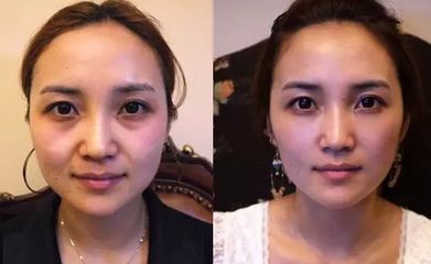 40岁去皱纹眼袋有效果吗,37岁眼袋有皱纹能去掉吗