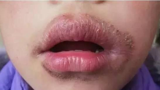 嘴唇起皮了为什么不能撕,反反复复嘴唇干裂起皮还痒怎么办