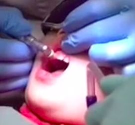 多图直击！牙医如何用抛光把孩子的牙洗干净？#葉子口腔科普#