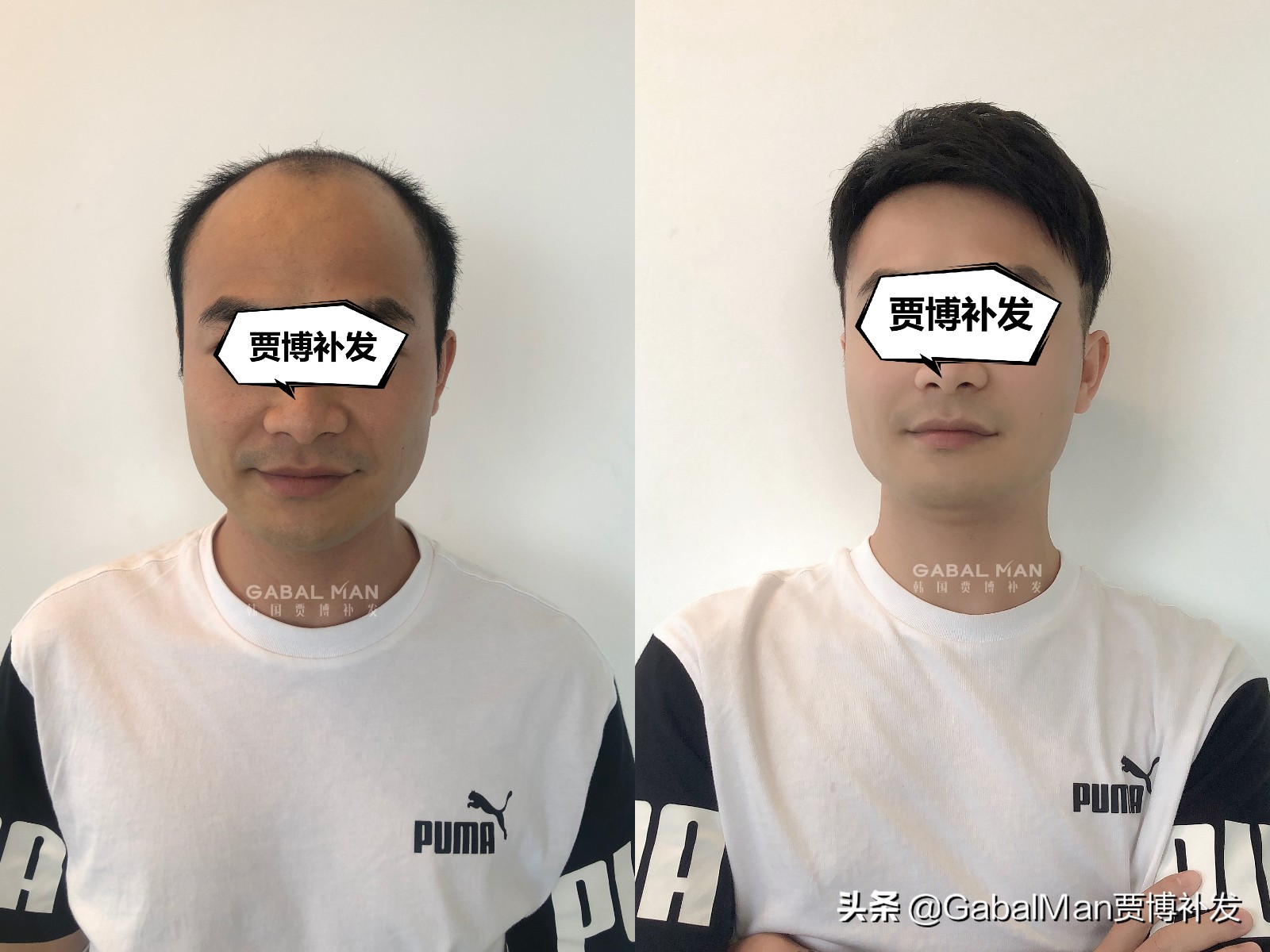 每天戴假发是什么体验？听听过来人怎么说