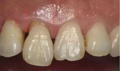 为什么吃东西会把牙磕掉,为什么吃东西后会牙齿出血呢