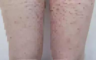 五岁女儿脸上长红疙瘩,6个月女宝身上长了红疙瘩