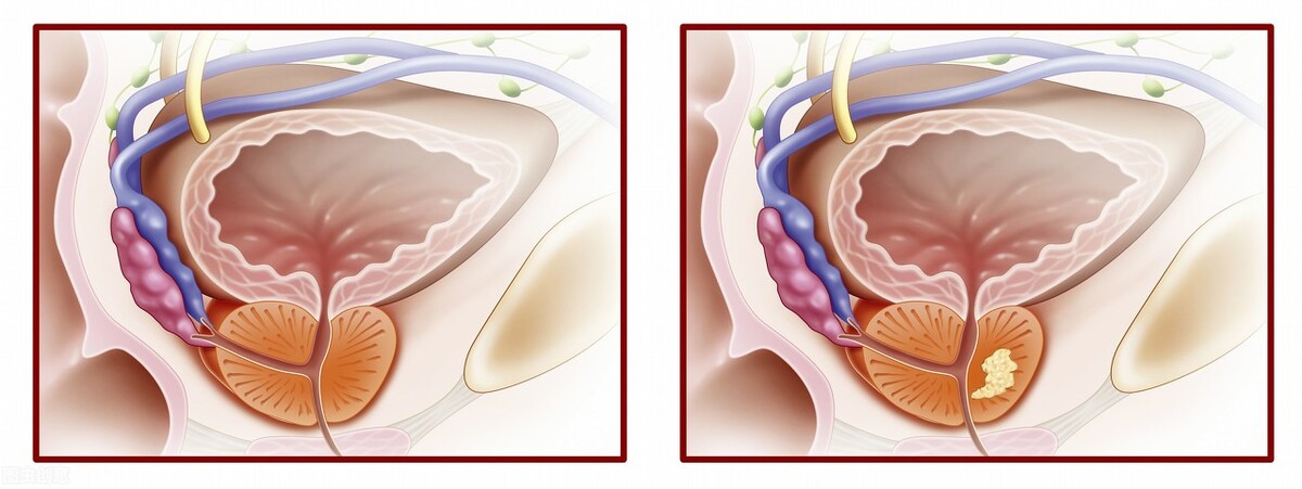 这个年龄段的男生最易被前列腺炎“盯上”！尿尿变这样一定要小心