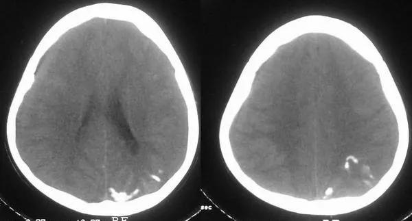 红胎记有时候明显有时候不明显,红胎记颜色浅容易治疗吗