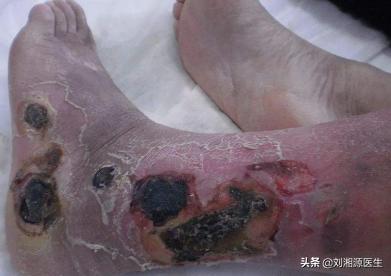 系统性血管炎怀孕能要吗,怀孕得了血管炎怎么办